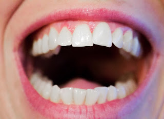 Answer: Is this a safe treatment for caries?